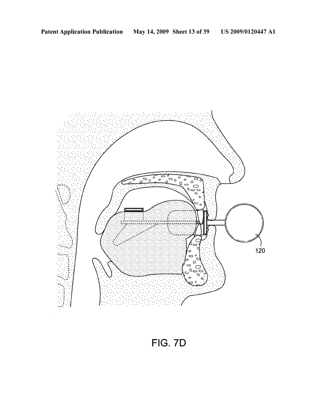 METHODS AND SYSTEMS FOR CREATING PRESSURE GRADIENTS TO IMPROVE AIRWAY PATENCY - diagram, schematic, and image 14