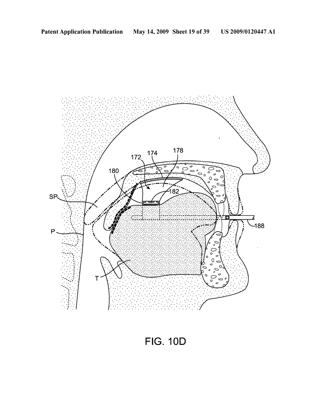 METHODS AND SYSTEMS FOR CREATING PRESSURE GRADIENTS TO IMPROVE AIRWAY PATENCY - diagram, schematic, and image 20