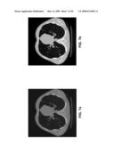 Nodule Detection diagram and image