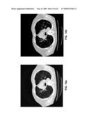 Nodule Detection diagram and image