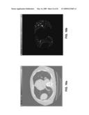 Nodule Detection diagram and image