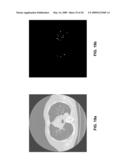 Nodule Detection diagram and image