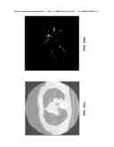 Nodule Detection diagram and image