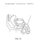 Medicament Delivery Device and a Method of Medicament Delivery diagram and image