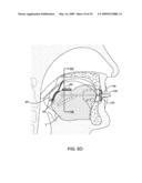 METHODS AND SYSTEMS FOR SALIVA MANAGEMENT WITH AN ORAL DEVICE diagram and image