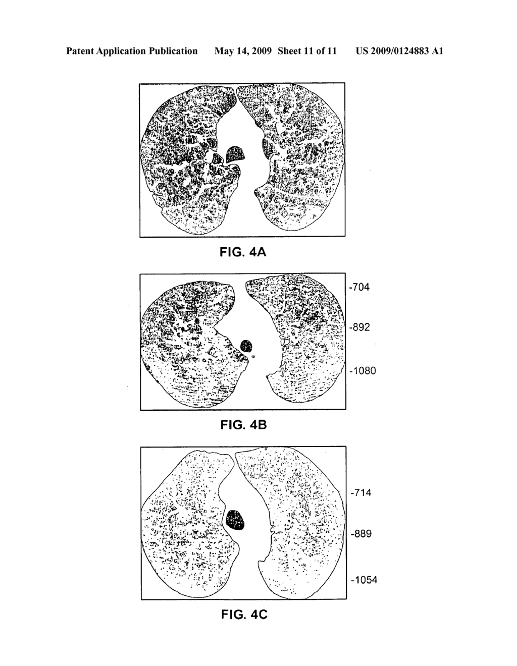 AIRWAY BYPASS SITE SELECTION AND TREATMENT PLANNING - diagram, schematic, and image 12