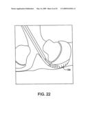 DEVICES AND METHODS FOR SELECTIVE SURGICAL REMOVAL OF TISSUE diagram and image