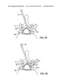 DEVICES AND METHODS FOR SELECTIVE SURGICAL REMOVAL OF TISSUE diagram and image