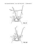 DEVICES AND METHODS FOR SELECTIVE SURGICAL REMOVAL OF TISSUE diagram and image