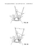 DEVICES AND METHODS FOR SELECTIVE SURGICAL REMOVAL OF TISSUE diagram and image