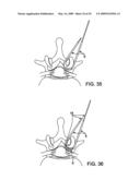 DEVICES AND METHODS FOR SELECTIVE SURGICAL REMOVAL OF TISSUE diagram and image