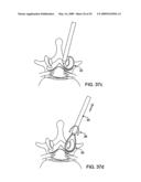 DEVICES AND METHODS FOR SELECTIVE SURGICAL REMOVAL OF TISSUE diagram and image