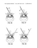 DEVICES AND METHODS FOR SELECTIVE SURGICAL REMOVAL OF TISSUE diagram and image