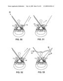 DEVICES AND METHODS FOR SELECTIVE SURGICAL REMOVAL OF TISSUE diagram and image