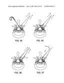 DEVICES AND METHODS FOR SELECTIVE SURGICAL REMOVAL OF TISSUE diagram and image