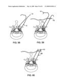 DEVICES AND METHODS FOR SELECTIVE SURGICAL REMOVAL OF TISSUE diagram and image