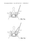 DEVICES AND METHODS FOR SELECTIVE SURGICAL REMOVAL OF TISSUE diagram and image