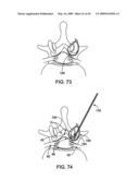 DEVICES AND METHODS FOR SELECTIVE SURGICAL REMOVAL OF TISSUE diagram and image