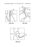 DEVICES AND METHODS FOR SELECTIVE SURGICAL REMOVAL OF TISSUE diagram and image