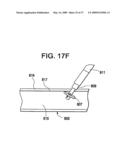 SYSTEMS AND METHODS FOR PUNCTURE CLOSURE diagram and image