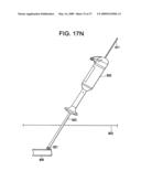 SYSTEMS AND METHODS FOR PUNCTURE CLOSURE diagram and image