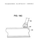 SYSTEMS AND METHODS FOR PUNCTURE CLOSURE diagram and image