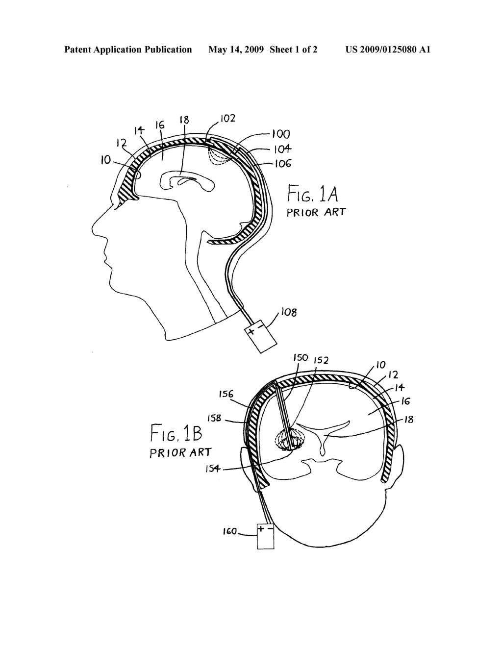 INTRAVENTRICULAR ELECTRODES FOR ELECTRICAL STIMULATION OF THE BRAIN - diagram, schematic, and image 02