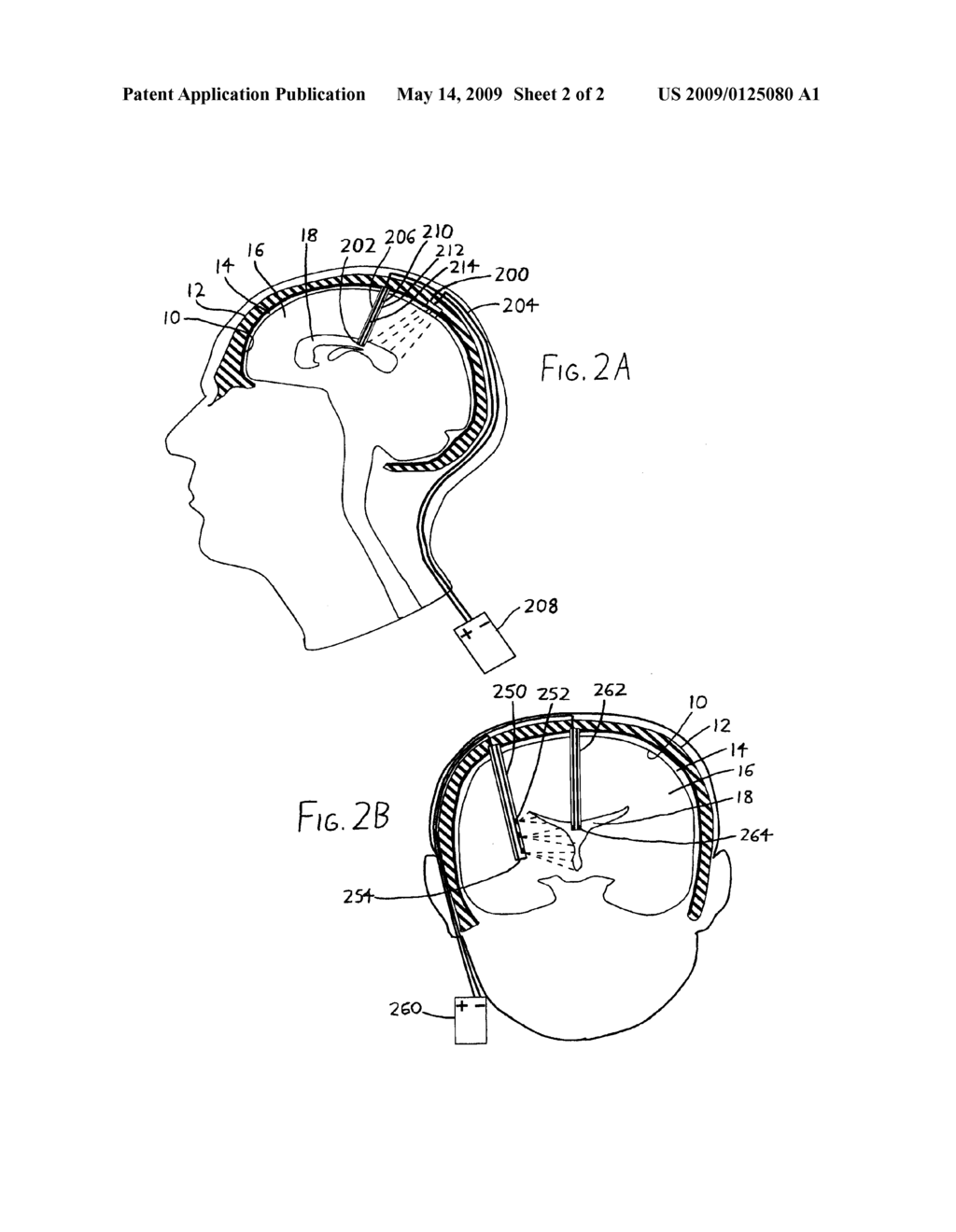 INTRAVENTRICULAR ELECTRODES FOR ELECTRICAL STIMULATION OF THE BRAIN - diagram, schematic, and image 03