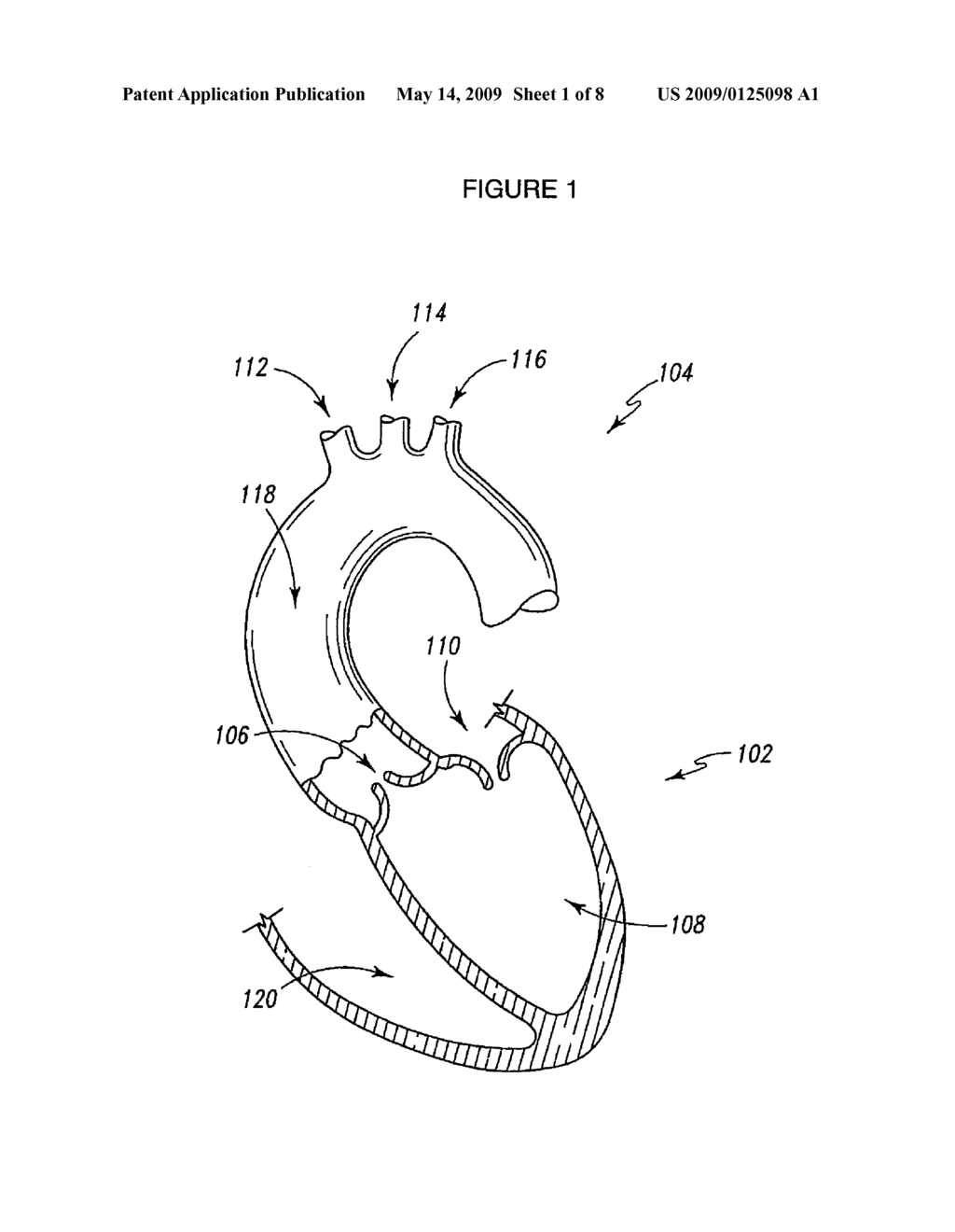 AORTIC VALVE STENT GRAFT - diagram, schematic, and image 02