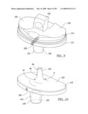 KNEE JOINT PROSTHESIS SYSTEM AND METHOD FOR IMPLANTATION diagram and image