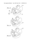 KNEE JOINT PROSTHESIS SYSTEM AND METHOD FOR IMPLANTATION diagram and image