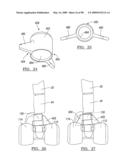 KNEE JOINT PROSTHESIS SYSTEM AND METHOD FOR IMPLANTATION diagram and image