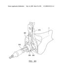 KNEE JOINT PROSTHESIS SYSTEM AND METHOD FOR IMPLANTATION diagram and image