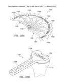 KNEE JOINT PROSTHESIS SYSTEM AND METHOD FOR IMPLANTATION diagram and image