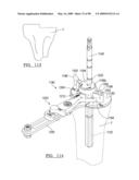 KNEE JOINT PROSTHESIS SYSTEM AND METHOD FOR IMPLANTATION diagram and image