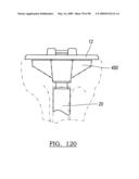 KNEE JOINT PROSTHESIS SYSTEM AND METHOD FOR IMPLANTATION diagram and image