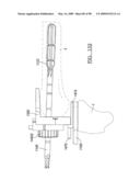 KNEE JOINT PROSTHESIS SYSTEM AND METHOD FOR IMPLANTATION diagram and image