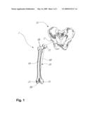 LEG ALIGNMENT AND LENGTH MEASUREMENT IN HIP REPLACEMENT SURGERY diagram and image