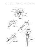 Bone supported palatal expansion appliance diagram and image