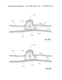 Lumen-traveling biological interface device and method of use diagram and image