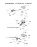 Lumen-traveling biological interface device and method of use diagram and image