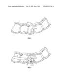 TISSUE REMOVAL SYSTEM AND METHOD USING REINFORCED LOOP diagram and image