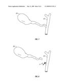 TISSUE REMOVAL SYSTEM AND METHOD USING REINFORCED LOOP diagram and image