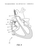 SYSTEM AND METHOD FOR POSITIONING IMPLANTABLE MEDICAL DEVICES WITHIN CORONARY VEINS diagram and image