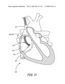 SYSTEM AND METHOD FOR POSITIONING IMPLANTABLE MEDICAL DEVICES WITHIN CORONARY VEINS diagram and image