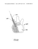 STEERABLE VERTEBROPLASTY SYSTEM diagram and image