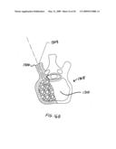 STEERABLE VERTEBROPLASTY SYSTEM diagram and image