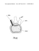 STEERABLE VERTEBROPLASTY SYSTEM diagram and image