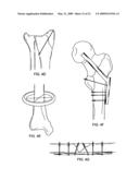 SYSTEM AND METHOD FOR THE FIXATION OF BONE FRACTURES diagram and image