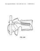 SYSTEM AND METHOD FOR THE FIXATION OF BONE FRACTURES diagram and image